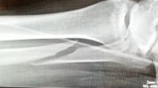 leg break.jpg